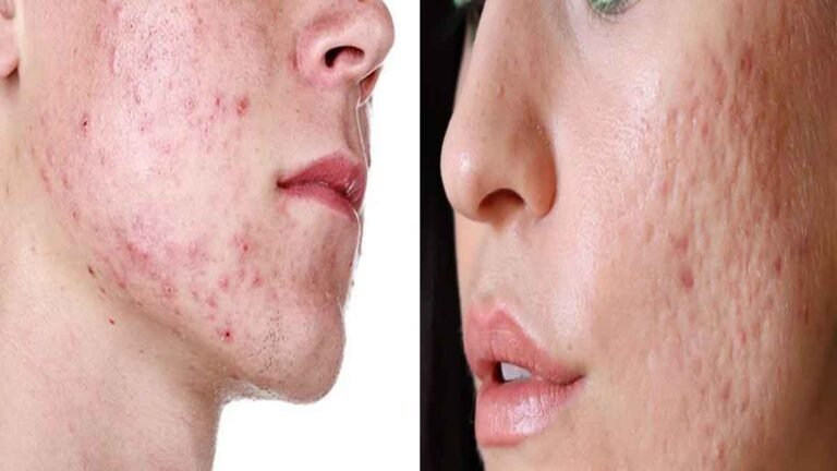 acne scars